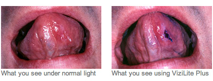 Oral Cancer Screening